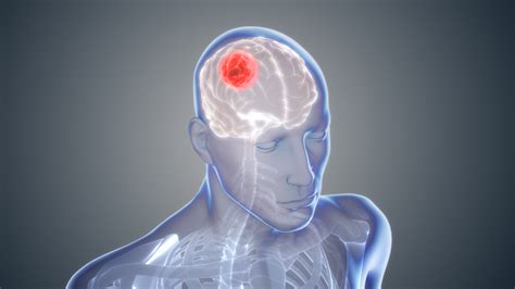 glioma brain cancer prevention