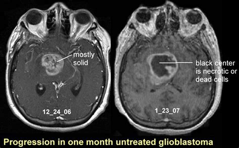 glioma vs glioblastoma mri