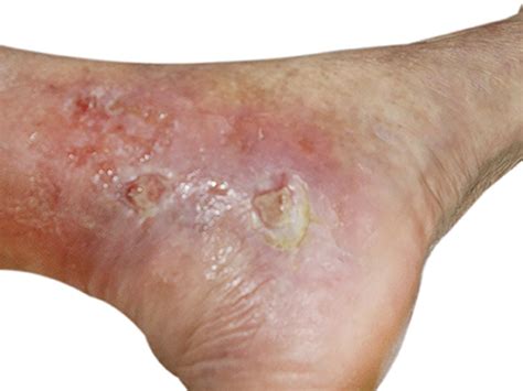 +14 Globuli Bei Ulcus Cruris