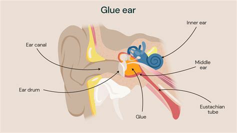 Glue Ear Explained