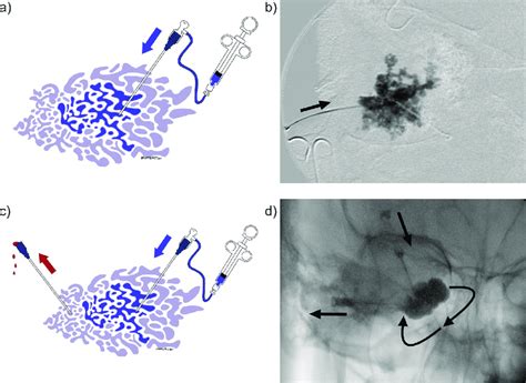 Glue Embolization Technique