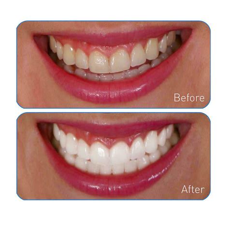 home.furnitureanddecorny.com:go smile teeth whitening light system reviews