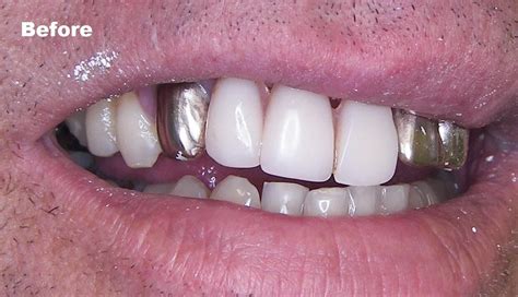 Trendy Gold Tooth Cap: Bold Statement!