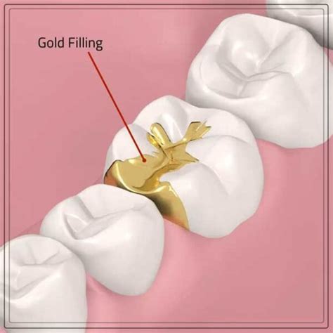 Gold Tooth Filling