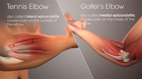 Golfers Elbow Cause