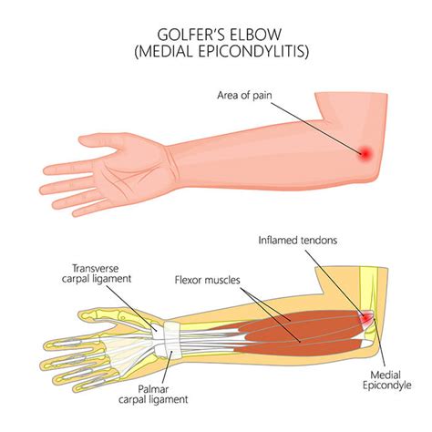 Golfers Elbow Nerve Damage