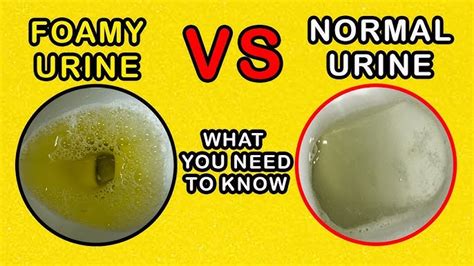 Good Bubbles In Urine