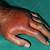 gout symptoms hand picture