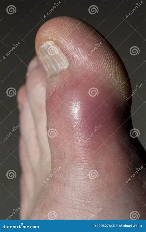 Gout Toe Blister