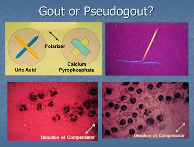 gout vs cppd crystals