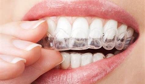 Gouttiere Blanchiment Dent Dentiste 2 GOUTTIERE BLANCHIMENT DES DENTS BLANCHISSANT DENTAIRE