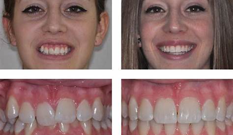 Gouttiere Dentaire Orthodontie Avant Apres Traitement Buccal Orthodontiste à Gatineau Dr Guay