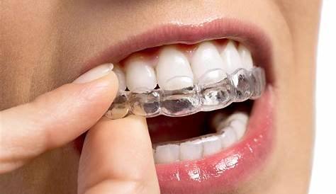 Gouttiere Dentaire Orthodontie Avis Pose D'une Gouttière Transparente Invisalign Centre