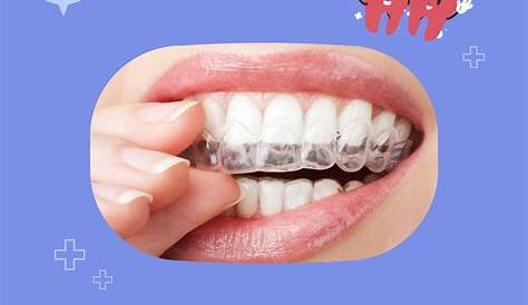 Gouttière dentaire pour redresser les dents.Invisalign