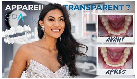 Gouttiere Dentaire Transparente Avant Apres Photos Après Traitement De Dentiste