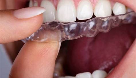 Quel matériau pour une orthèse orale ? DTM et Occlusion
