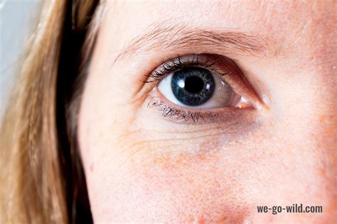 10 Ursachen für dunkle Augenringe Gesunde Wahrheit
