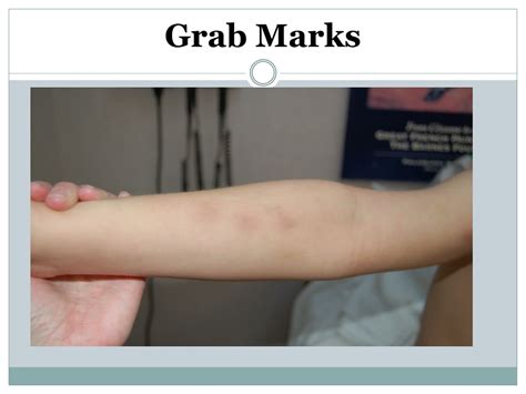grab marks on arm