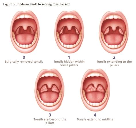 grades of tonsillitis