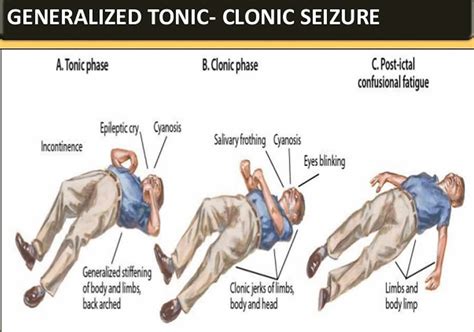 grand tonic clonic seizure