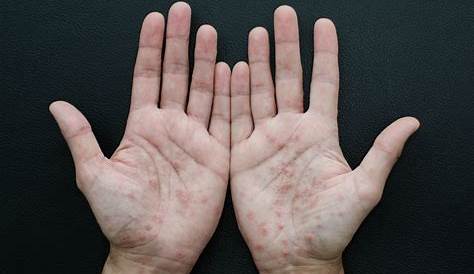 Pustulosis palmoplantar en manos y pies - Revista Artritis y Reumatología