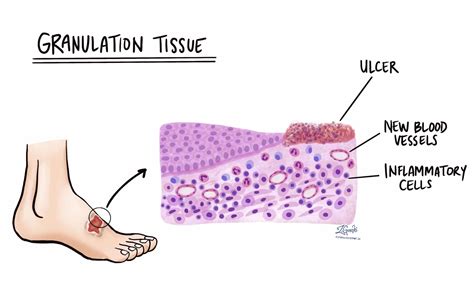 Granulation Tissue Pictures: Understanding Healing's First Stage
