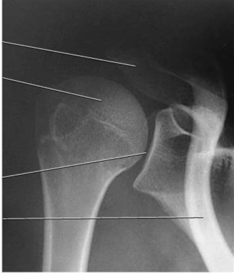 Grashey X Ray Labeled