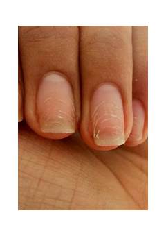 Green Nail Bed After Acrylics: Causes, Treatment, And Prevention