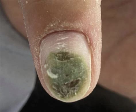 Green Nails Bacteria