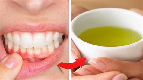 Green Tea On Gums