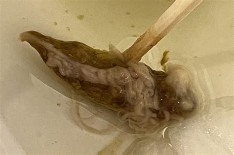Grey Strings In Poop