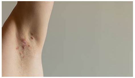 Groin Area Inner Thigh Hidradenitis Suppurativa Dermatology JAMA Dermatology