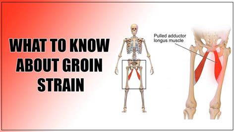 Effective Groin Pull Recovery: Speed Up Your Healing Process