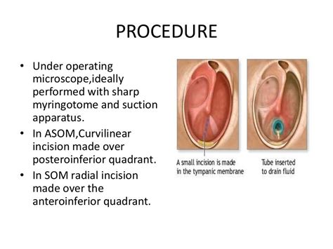 Grommet Insertion Procedure