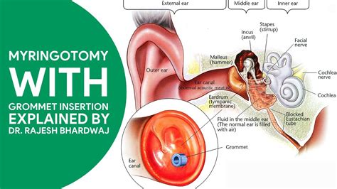 Grommets Adults Procedure