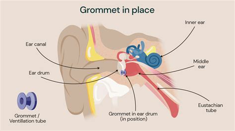 Grommets Care