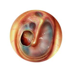 Grommets Perforated Eardrum