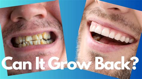 growing enamel back on teeth
