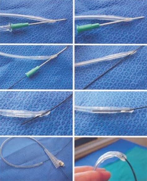Guide Wire Catheter Technique