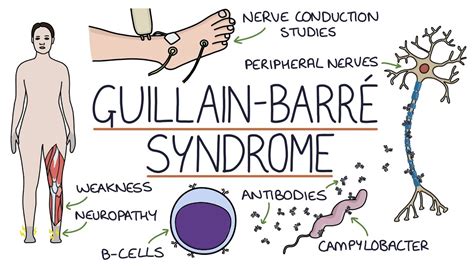 guillain barre syndrome symptoms