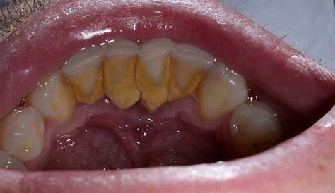 Gum Disease Plaque Build Up Dental Tartar, And Stock Image C023