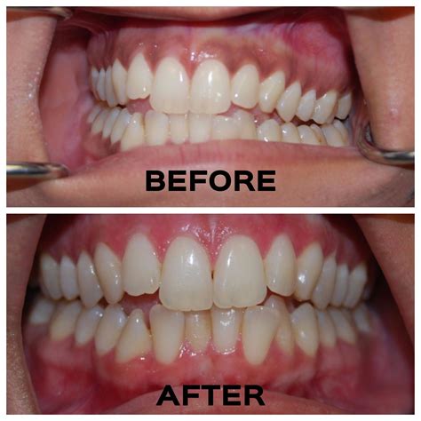 My Gums Are White After Teeth Whitening TeethWalls