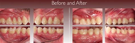 gum augmentation surgery