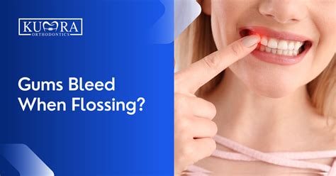 Gums Bleed Profusely When Flossing