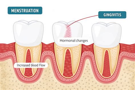 Gums Bleeding Menstruation