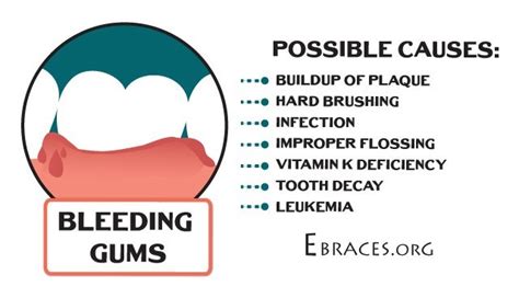 Gums Bleeding When Flossing With Braces