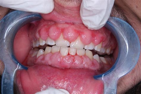 Gums Growing Under Braces