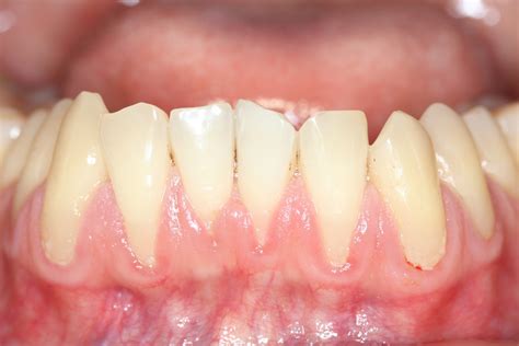 Gums Receding Below Teeth