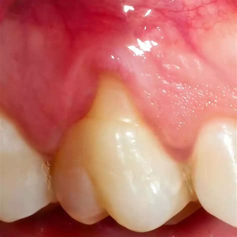 Gums That Appear To Be Pulling Away From The Teeth