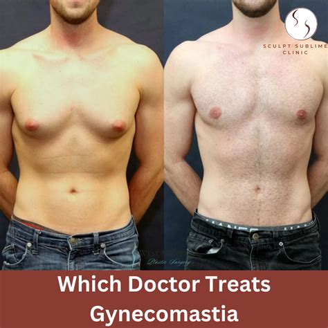 Gynecomastia
